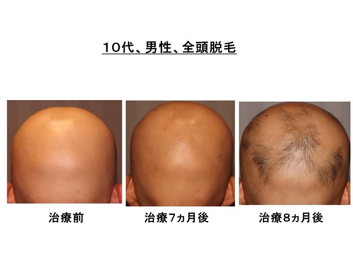 円形脱毛症　病院